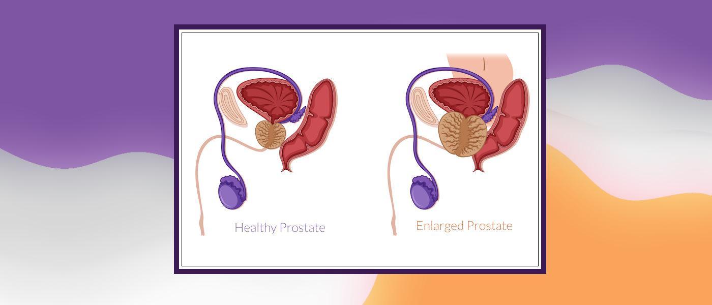 Benign Prostate Hyperplasia (BPH)